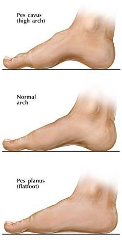 tendonitis sole of foot