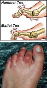 Hammer Toe Correction & Plantar Plate Repair - Dr Greg Sterling